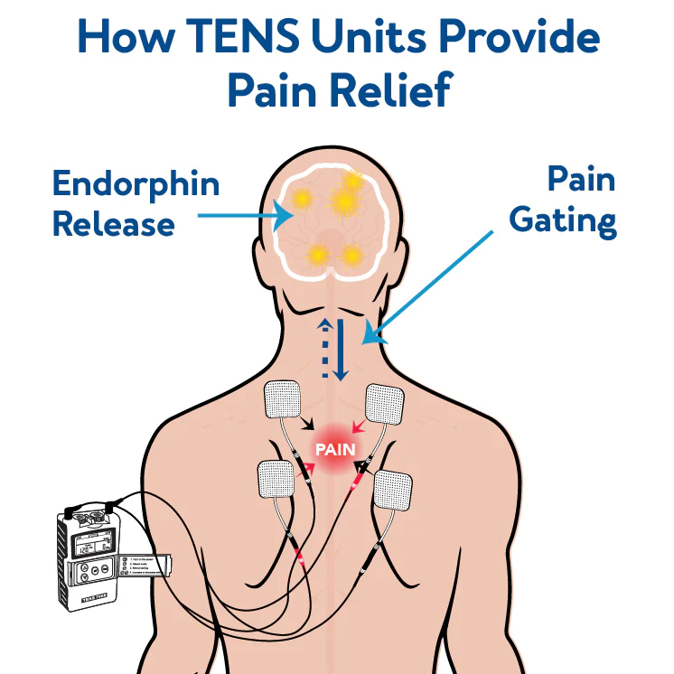 TENS : Using Electrical stimulation for Pain Relief